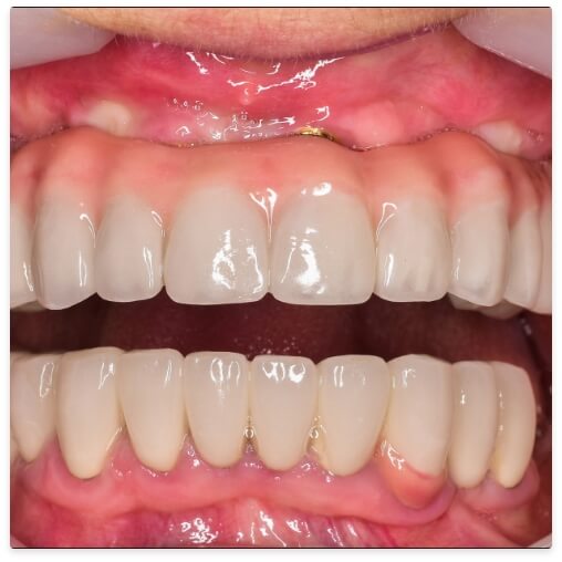 Closeup of smile with full mouth dental implants